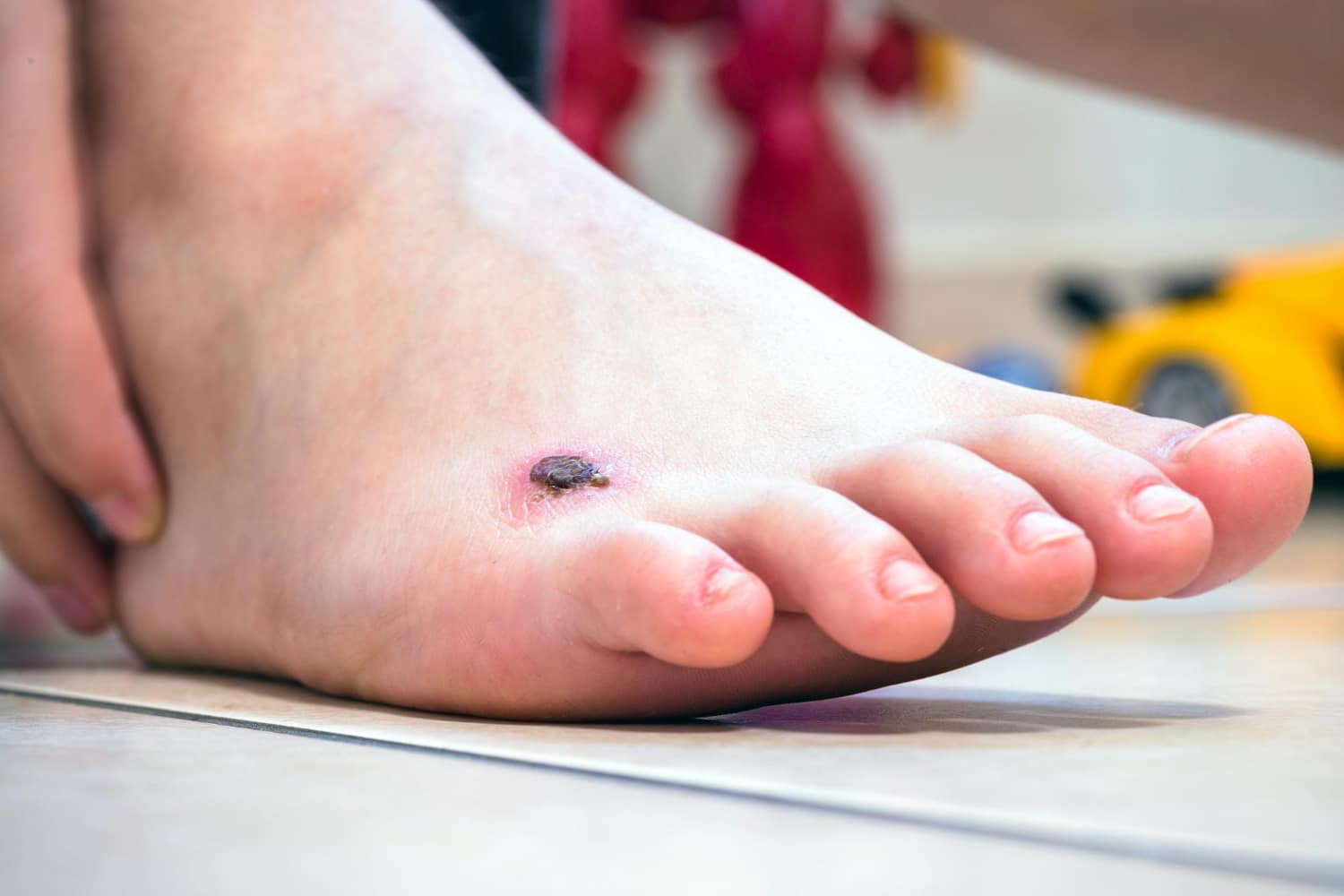 Comment soigner une ampoule infectée au pied ? Novabaume