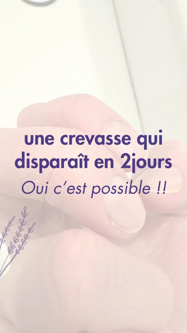 Une crevasse qui fait mal, vous connaissez ?
La peau se fendille, et que c’est douloureux ! 😓

J’ai fait le test en réel et en 2jours ma crevasse a disparu (et sans trucages)

✨Jour 1 : le constat : une crevasse qui saigne, mal placée (en même temps est ce qu’une crevasse peut elle bien se placer ?)

✨le soir j’applique Novabaume généreusement (et mets un pansement pour ne pas en mettre le partout )

✨Jour 2 - le lendemain : la plaie commence déjà à se refermer ! Ca fait mal mais beaucoup moins

✨le soir : de nouveau je fais une petite poupée avec du Novabaume, pour la nuit

✨ Jour 3 - plus mal, presque tout refermé !

Alors bleufflant ? Dites-nous vos impressions en commentaires

Quand on vous disait que ce baume était magique et qu’il réparait tous les bobos du quotidien !

#novabaume #bretagne #soindelapeau #baumemagique #madeinfrance #viedemaman #runner #running #soindespieds #soindesmains